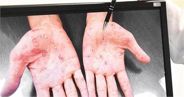 年輕男子露營完「手掌冒紅斑」 就醫竟發現感染梅毒