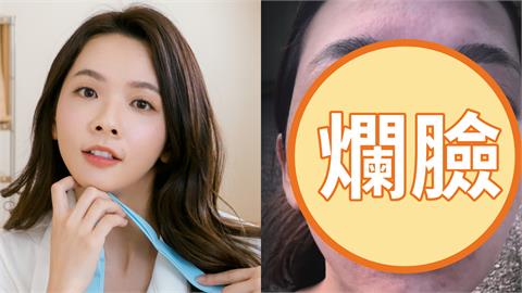 滴妹飛夏威夷做「1件事」大過敏！紅疹爬滿身「近距離爛臉照」嚇壞眾人