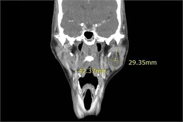 婦人左臉突然「凸」一塊！   4公分腫塊竟是少見腺細胞癌