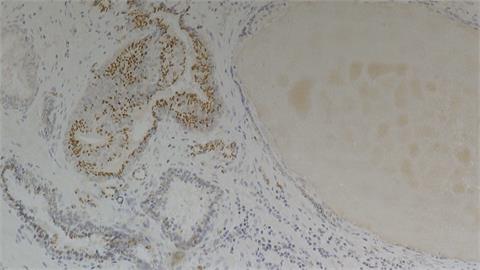 澳洲大學找到「腫瘤標記」　幫助提早發現前列腺癌