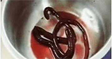 超噁！男子常吃生魚感染「世界最大人體寄生蟲」取出還在蠕動