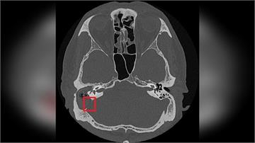 慢性中耳炎勿輕忽！小心併發膽脂瘤造成聽力與神經損傷