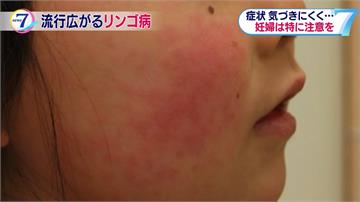 到日本旅遊小心！東京「蘋果病」爆發 孕婦感染恐流產