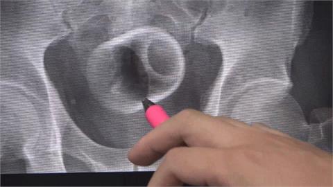 男腹痛難耐3天以上沒解便　醫驚見骨盆腔有「這東西」