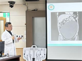 19歲女大生月經異常才知藏「30cm巨腫瘤」   機械手臂順利拆彈