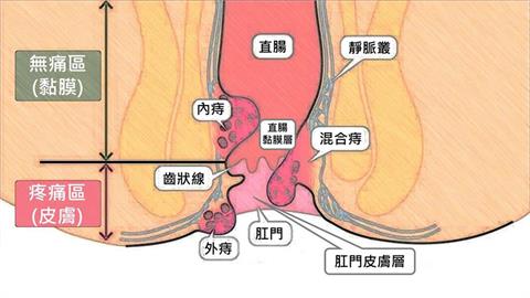 妹子成人版貼「高舉雙腿」性感辣照！竟曝「1隱憂」醫嘆：外痔露出來