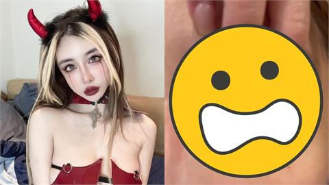 雪碧砸近千萬整形「眼睛留下後遺症」!她崩潰喊「像被針插」慘況曝光