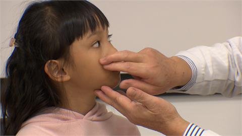 狂發燒流鼻水！6歲女童感冒後急性鼻竇炎　竟是口罩戴緊緊惹禍