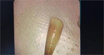 24歲男聚餐吐血送醫！醫生從肺部取出「這物」　他傻眼：小學弄丟的