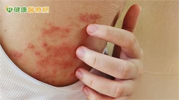 癢到睡不著、抓到流血？醫曝異位性皮膚炎3大關鍵解方