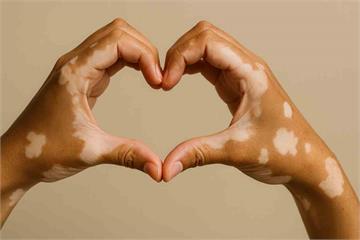 皮膚長白斑無藥可醫？什麼是白斑？如何停止擴散？治療方式一次看清！