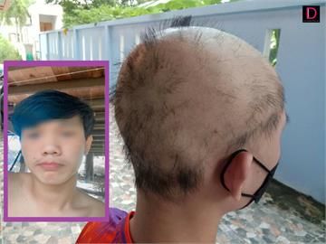 19歲就變禿頭　泰國青年打完2劑科興疫苗竟「頭髮狂掉」無藥醫