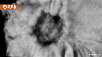 胃癌風險暴增6倍！政府緊急啟動免費篩檢救命計畫