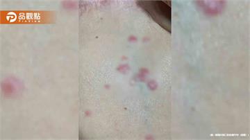 腹部突然有紅疹不痛不癢！竟是乳癌轉移 醫曝2大警訊別輕忽