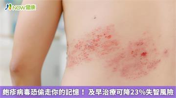 皰疹病毒恐偷走你的記憶！ 及早治療可降23%失智風險
