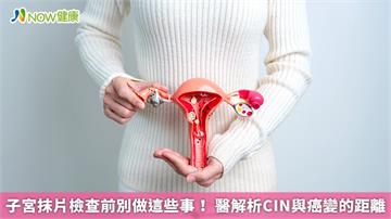 子宮抹片檢查前別做這些事! 醫解析CIN與癌變的距離