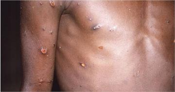 M痘疫情持續!11月新增7例「皆本國青壯男性」 全台案例分布曝光