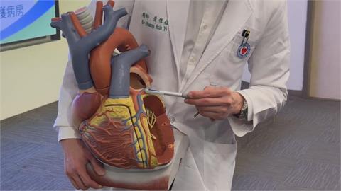 72歲女子心臟血管「長石頭」　胸痛、冒冷汗一週險奪命