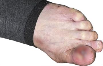 腳趾紅腫、化膿一年多難穿鞋   婦人「惡癌」錯當甲溝炎險丟命！