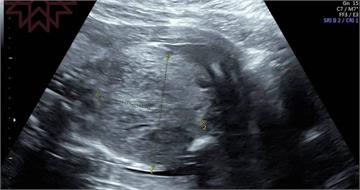 孕婦產檢發現「寶寶肚子有巨大腫瘤」醫嘆：1周後胎兒心跳停止了