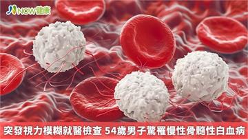 突發視力模糊就醫檢查 54歲男子驚罹慢性骨髓性白血病