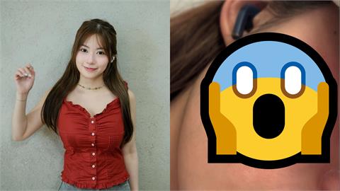 27歲甜美女星敷面膜「險毀容」！親吐250字「病情心聲」：臉上像10級火災
