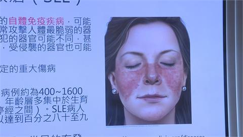 不只坣娜!港星周海媚也因罹患紅斑性狼瘡病逝