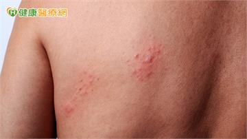 皮膚病一定能「斷根」？醫破解過敏、香港腳與帶狀皰疹常見迷思