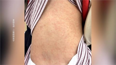 天冷小孩狂冒紅疹! 兒醫:"內刷毛"衣物釀皮膚災難