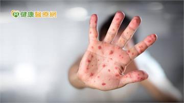 【闢謠】感染麻疹可獲抗體！？輕忽恐釀重症與嚴重併發症