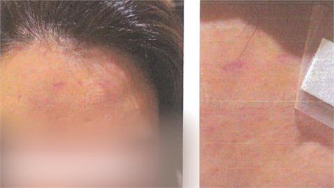先和解後反悔！彰化貴婦洗頭　遭美髮助理刮傷額頭「憤而提告」