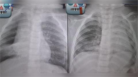 阿嬤餵孫整顆花生「卡氣管3天長肉芽」！見「肺塌陷」險喪命⋯醫師發文怒斥