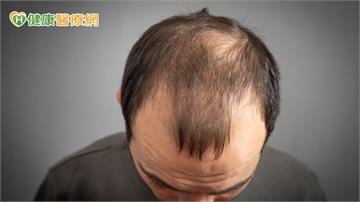 禿頭族新福音？台大研發「含天然脂肪酸」生髮精華　20天促小鼠毛髮再生