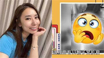 陳怡婷不理會小毛病拖出惡疾？手術切除「13顆肌瘤」驚悚照流出！