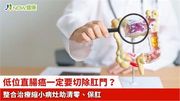 低位直腸癌一定要切除肛門？ 整合治療縮小病灶助清零、保肛