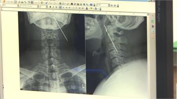 8公分鋼釘人體迷航三年 穿脖直插入左頸內顱骨