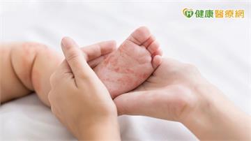 今年首例麻疹境外移入！8個月男嬰自越南返台確診　7國列第二級警示