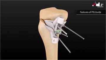 保膝手術搭配醫療3D列印科技 造福患者