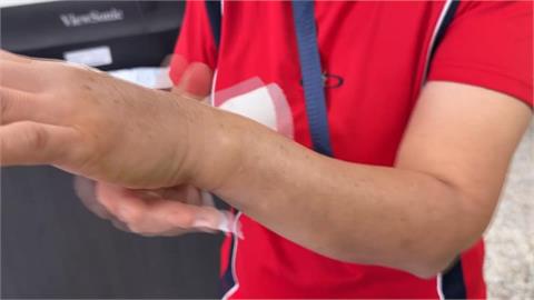 彰化婦車禍手骨折腫如「麵龜」　玉鐲卡手痛不欲生「鐵鎚敲碎」