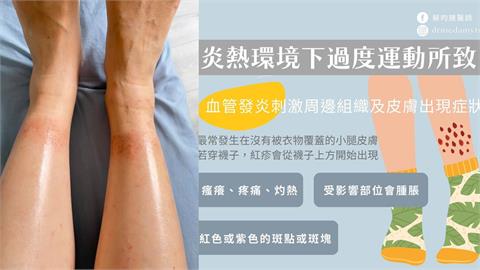 出國暴走腳踝起紅疹超癢？醫曝「迪士尼皮疹」高風險族群...教「6招」快速舒緩