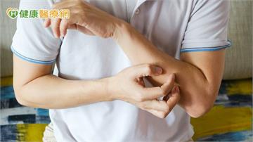 皮膚缺水「冬季癢」　藥師授「3不5藥」保養肌膚
