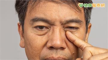 開車只能靠單眼！40歲男飽受顏面痙攣所苦　醫解析治療重點