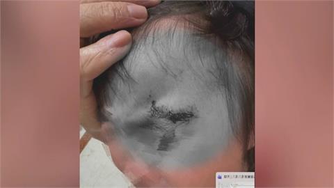 幼兒園校狗發狂！咬女童濺血縫八針　家長控園方不讓看監視器