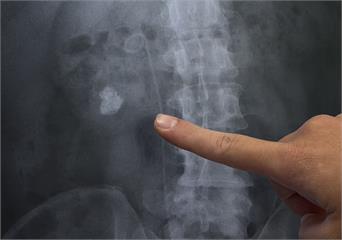 30歲男「後腰痠痛」當肌肉拉傷白衝復健科   其實腎結石作怪！