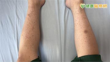 8歲童全身冒小血斑、剔牙大出血　竟是「免疫性紫斑症」險致命