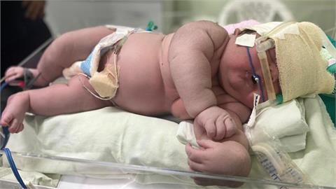 剛出生就穿1歲衣！巴西誕7.3公斤超級巨嬰　竟是因母患「超常見疾病」