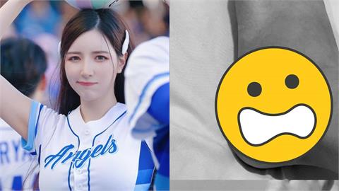 南珉貞熱舞慘摔「腳踝翻船」站不起!「腫到大片青紫」傷勢照流出嚇瘋網