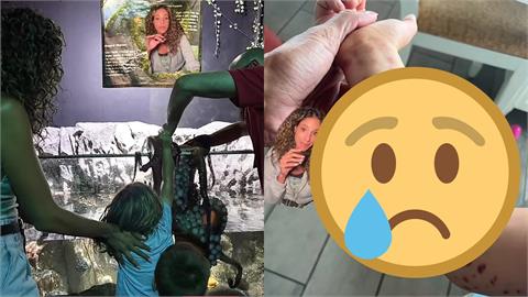 6歲男童遭章魚「纏手不放」　6大人掰8隻腳手臂全是紫色吸盤印