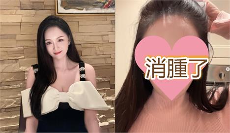陳喬恩「打電波臉腫」遭酸整成網紅臉！不忍抖「0濾鏡現況片」網驚：是誰