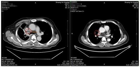 癌末曙光！免疫細胞合併療程抗癌成功　肺腺癌4期癌友喜獲重生